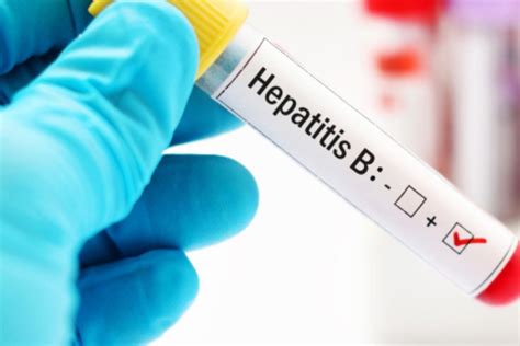 Hepatitis B cómo se contagia síntomas y cómo prevenirla Walac