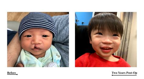 Pediatric Cleft Lip Surgery New York