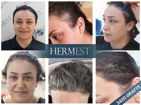 Hair Transplant For Women In 2023 Hermest Clinic Turkey