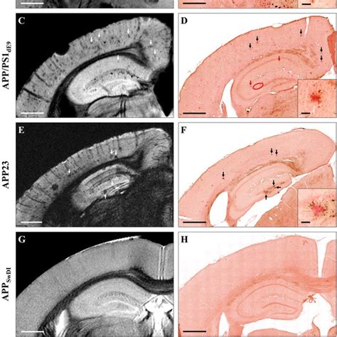 Cardiac Magnetic Resonance Imaging In Cardiac Amyloidosis A B Cardiac