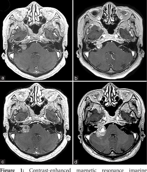 Figure From Cerebellopontine Angle Metastasis Of A Neuroendocrine