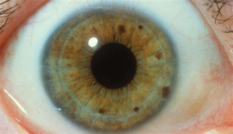 Iridology Detecting Impaired Organ Function With The Iris Clinical Advisor