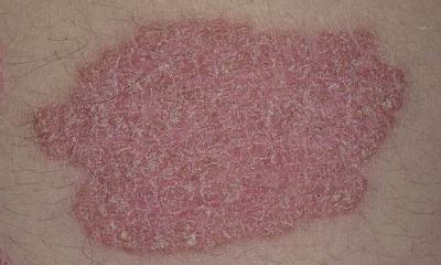 Plaque psoriasis symptoms pictures, what does plaque psoriasis look like, images of plaque ...