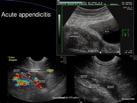 Appendicitis During Pregnancy