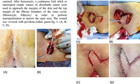 Figure 1 From Modified Sinotomy Versus Modified Limberg Flap In