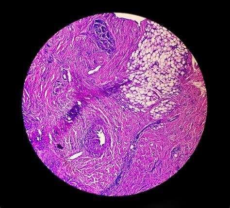 La Vista Microscópica Del Carcinoma Basocelular Es Un Tipo De Cáncer De