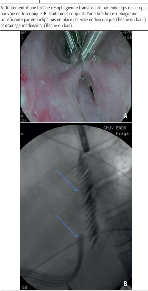 Figure From Syndrome De Boerhaave Mise Au Point Sur La