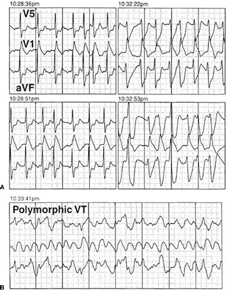 Coronary Artery Disease And Stable Angina Diseases And Conditions