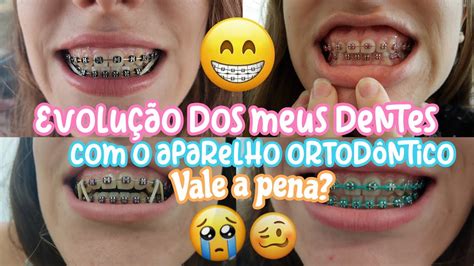 MUDANÇAS NOS DENTES O APARELHO ORTODÔNTICO Vale a pena fotos