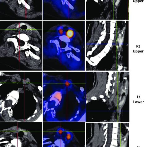 The Single Photon Emission Computed Tomography Computed Tomography With