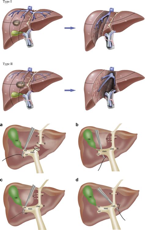 Anatomic Mesohepatectomy Versus Extended Hepatectomy For Patients With