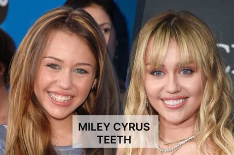 Miley Cyrus Teeth: Transform Your Smile with Lingual Braces