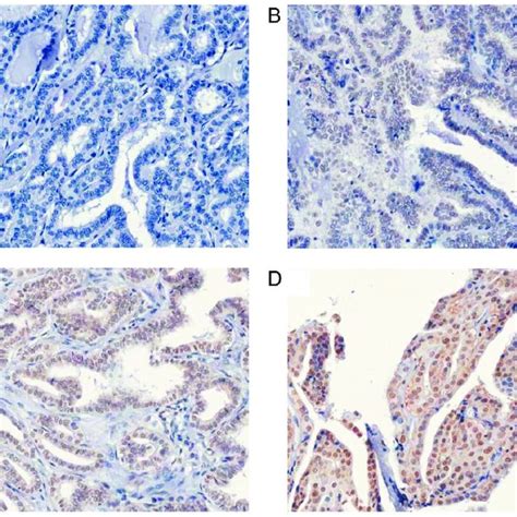 Fk Binding Protein Expression Level In Papillary Thyroid