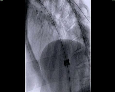 Passage Of A Bougie Dilator Across An Esophageal Stricture Under