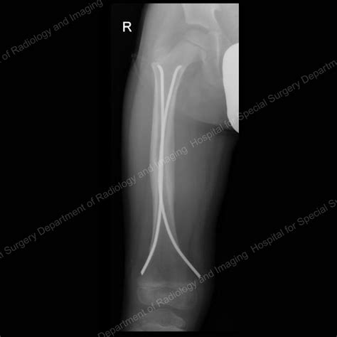 Intramedullary Nail Femur Physical Therapy Protocol - Nail Ftempo