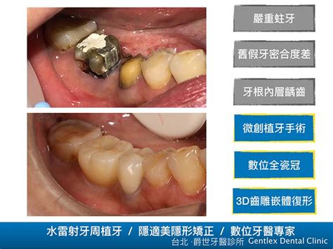 水雷射微創植牙 爵世美學．爵世牙醫診所