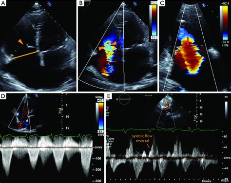 The Echocardiographic Assessment Of Severe Tricuspid Regurgitation