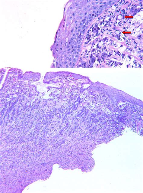 Biopsy from endoscopy. High power and low power images from endoscopic ...