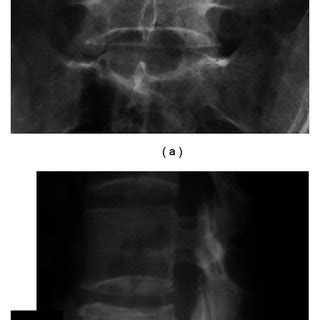 Plain Radiographs Before And After The First Surgery January 2007