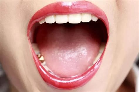 Candid Mouth Paint For Oral Thrush Treatment Ml Ebay