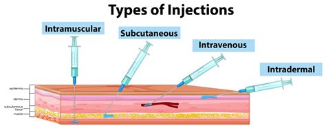 types  injections diagram  vector art  vecteezy