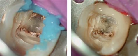 Access Cavity Preparation Pocket Dentistry