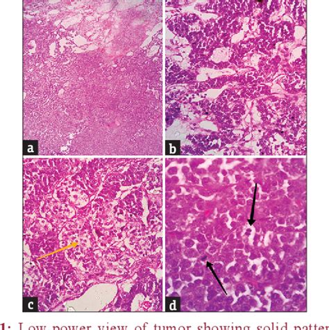 Figure 1 From Poorly Differentiated Ovarian Sertoli Leydig Cell Tumor