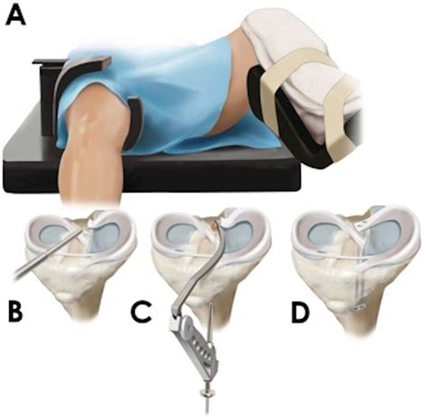 Meniscal Root Tears A Silent Epidemic British Journal Of Sports Medicine