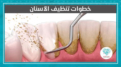 خطوات تنظيف الأسنان في مراكز علاجك الطبية Youtube