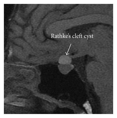 A Sagittal T Weighted Mri Of The Head Shows A Suprasellar