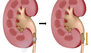 Lithotripsy