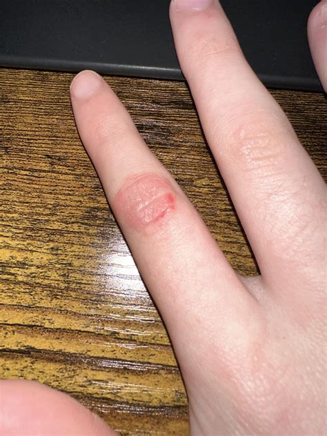 Knuckle Swollen Itchy And Now Showing Red Spots Rmedical