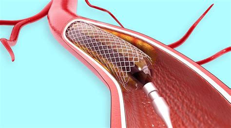 O Que é A Angioplastia Coronária Cardio 365º