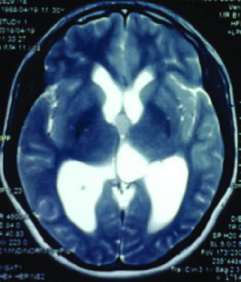 Preoperative T2 Weighted Mri Showing A Colloid Cyst At The Foramen Of Monro Download