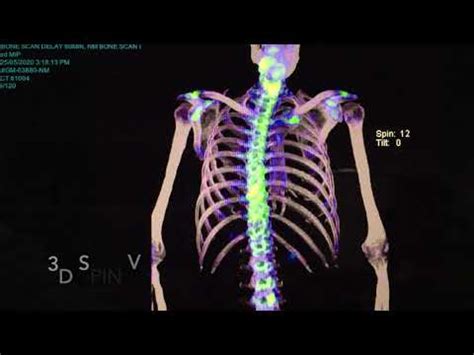 The Nuclear Medicine Whole Body Bone Scan Ct Spect A Very Useful