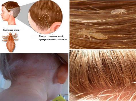 Аэрозоль Пара плюс от вшей и гнид – как применять