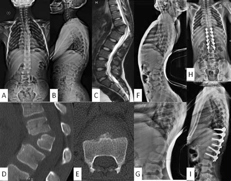 A And B—pre Operative Whole Spine Standing Radiograph Showing Download Scientific Diagram