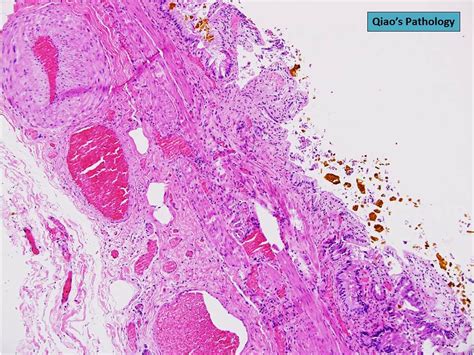 Qiao S Pathology Angiodysplasia Of The Gallbladder A Photo On Flickriver