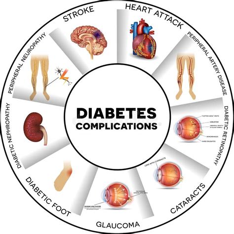 Diabetes Complications Stock Illustration Illustration Of Illustration