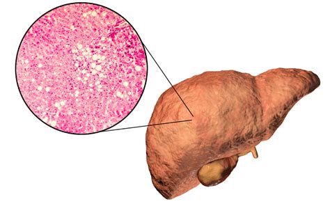 Fatty Liver Disease Prevention Diagnosis And Treatment Gidoc Jhb