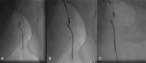 Outback Catheter Assisted Simultaneous Antegrade And Retrograde Access For Subintimal