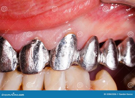 Metal Basis Dental Bridge Stock Photo Image Of Human 32863306