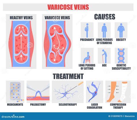 Varicose Vein Causes And Treatment Medical Poster Stock Vector