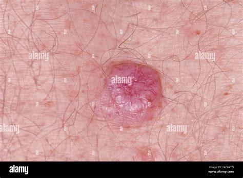 Basal Cell Carcinoma Skin Cancer Close Up Of A Nodular Basal Cell Carcinoma Bcc On The Back