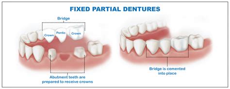 FIXED PARTIAL DENTURES - Modern Dental Clinic, Kozhikode