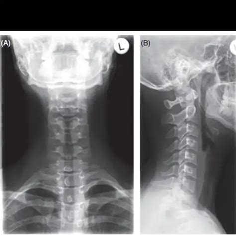 X-Ray Cervical Spine AP and Lateral View Price In Delhi, India | Ganesh Diagnostic