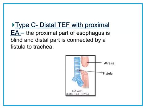 Presentation On Esophageal Atresia And Tracheoesophageal Fistula Ppt