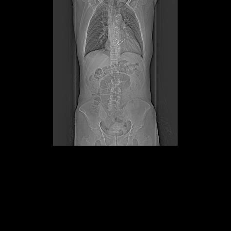 File Marfan Syndrome With Ascending Aortic Aneurysm And Stanford A