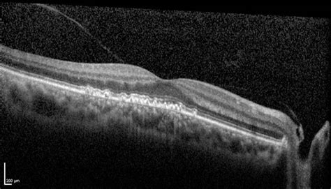 Cuticular Drusen - Retina Image Bank