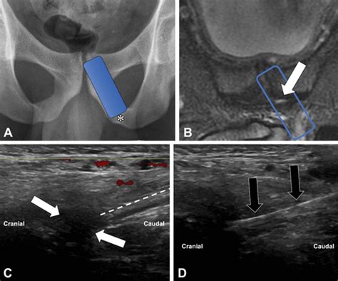 Ilioinguinal Nerve Block Ultrasound